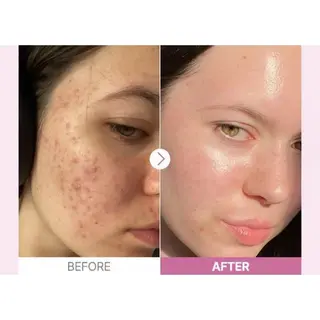 سرم نیاسینامید 15 کوزارکس 